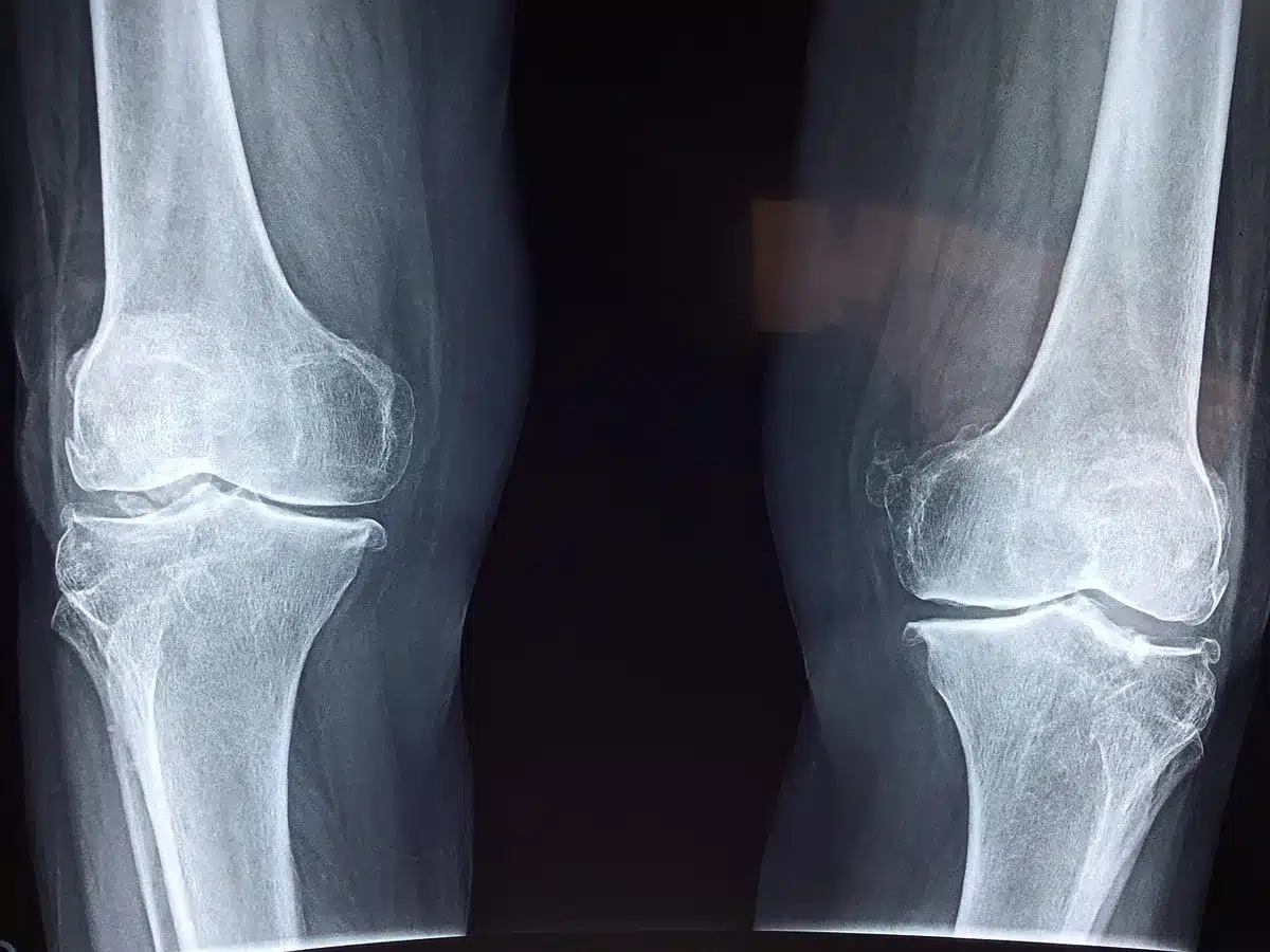 Radiographie montrant une articulation avec signes d'usure et d'arthrose